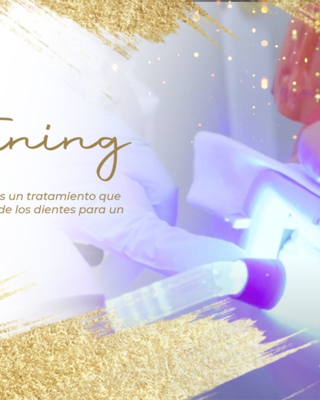 ¿En qué consiste el WHITENING: Blanqueamiento Dental?