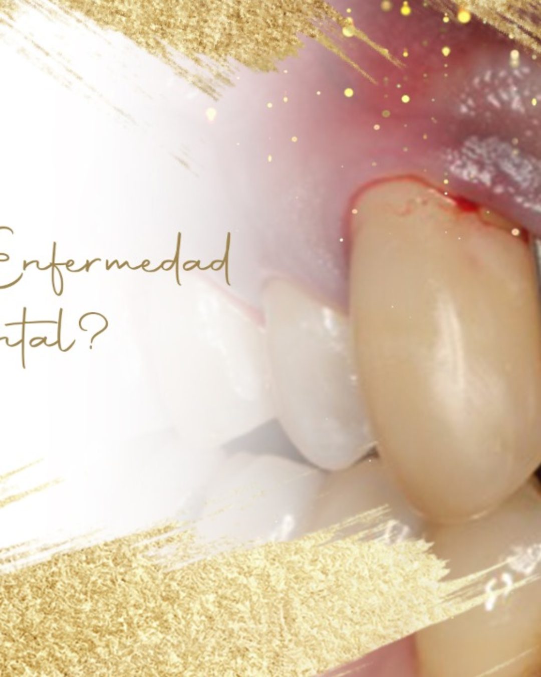 Sabias que muchas personas sufren de Enfermedad Periodontal y no lo saben?