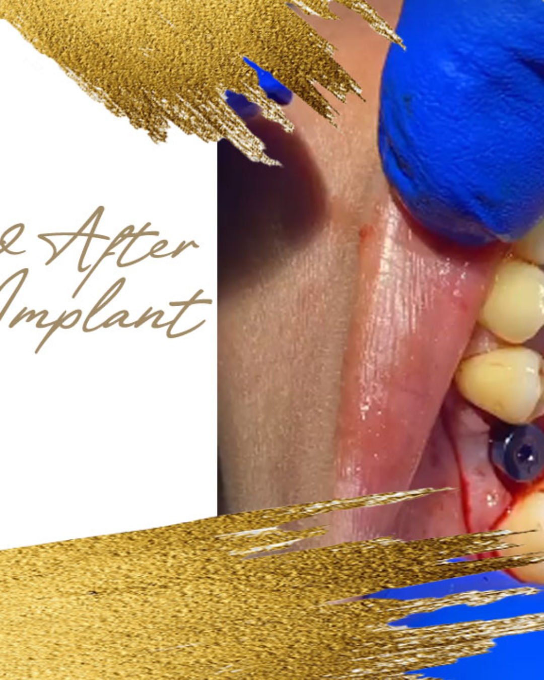 Before and After Dental Implant