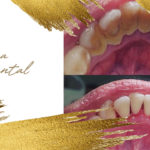 Limpieza Dental Doctora Elena Solis